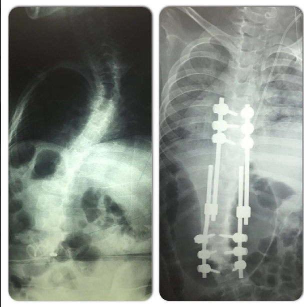 Escoliose Doutor Pedro Coutinho Ortopedista Coluna Vertebral